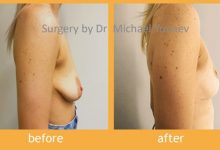 Photo of You Can Easily Lift Your Breasts With A Surgical Procedure
