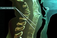 Photo of Know the early symptoms of ankylosing spondylitis and how to treat it