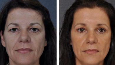 Photo of Even The Smallest Cosmetic Surgeries Have A Big Effect