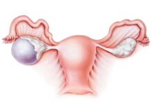 Photo of Ovarian Cysts –Know About Symptoms, Causes and Treatment Options