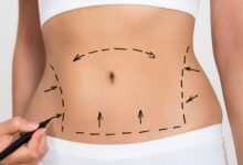 Photo of Liposuction vs. Weight Loss Surgery: Which Should You Get
