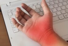 Photo of 3 Common Symptoms of Carpal Tunnel Syndrome