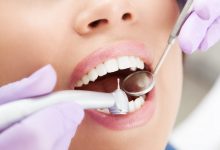 Photo of Various Types Of Dental Fillings | Detailed Knowledge
