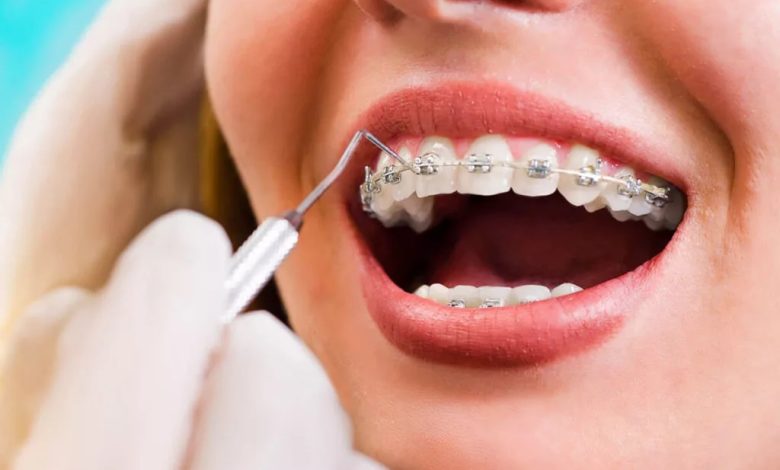 Photo of Braces Price: What To Expect When Straightening Your Teeth