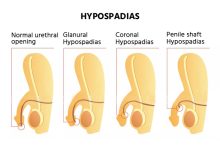 Photo of Understanding Hypospadias Surgery