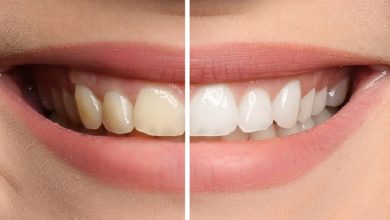Photo of How to Choose the Right Teeth Whitening Materials?