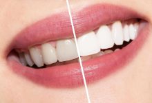 Photo of The Necessary Points about Teeth Whitening Process 