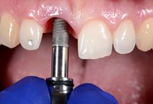 Photo of Traditional vs. All-on-4 Dental Implants