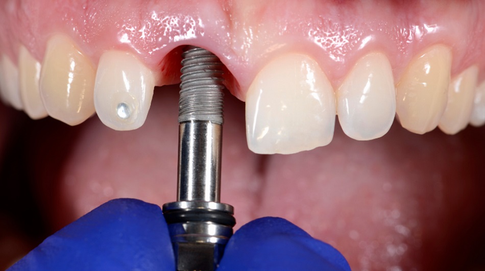 Dental Implants