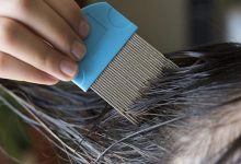 Photo of Effective Lice Treatment: What Virginia Residents Need to Know