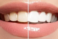 Photo of Pearl Perfection: The Perks Of Teeth Whitening