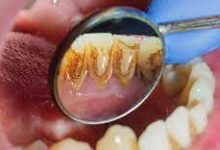 Photo of Periodontal Pockets: Why Do You Have Them and How to Prevent Them from Developing in Dieppe, NB