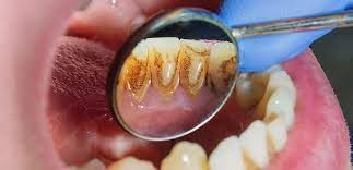Photo of Periodontal Pockets: Why Do You Have Them and How to Prevent Them from Developing in Dieppe, NB