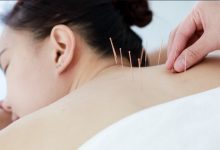 Photo of How Acupuncture Supports Stress Relief and Relaxation